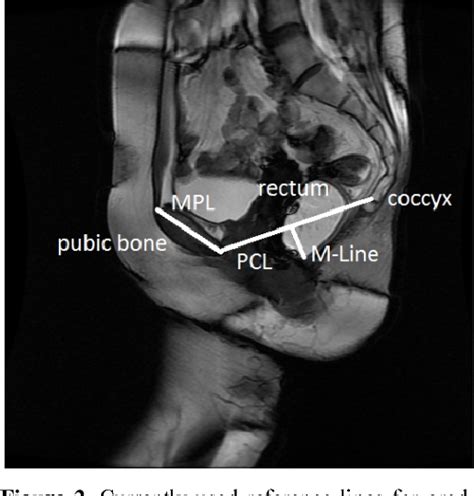 figure 2 from image based measurements for evaluation of pelvic organ prolapse semantic scholar
