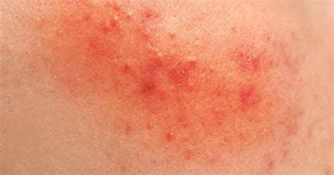 What Do Red Spots On Skin Mean Findatopdoc