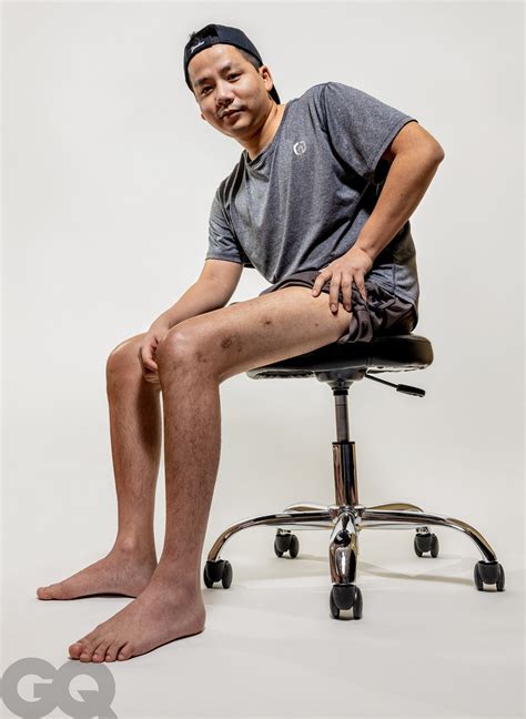 Inside The World Of Leg Lengthening Meet The Men Paying Six Figures To