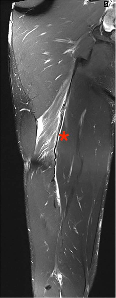 Mri Of Grade 3c Large Tear Involving 50100 Of Muscle Cross Sectional
