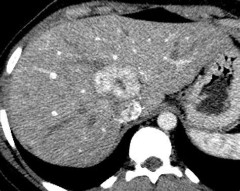 Liver Atlas Diagnosis Focal Nodular Hyperplasia Fnh