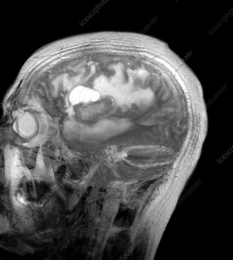 Brain Cancer Mri Scan Stock Image C0103408 Science Photo Library