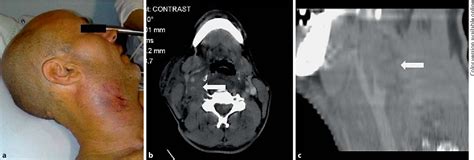 Figure 1 From Neck Hematoma After Intravenous Thrombolysis For Stroke