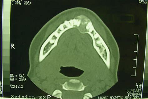 Movable Lump On Jaw Bone Gertyren
