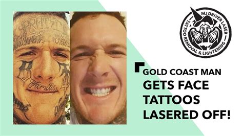 Gold Coast Man With Face Tattoos Gets Them Lasered Off Youtube