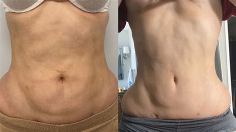 Pictures Of Fibrosis After Liposuction A Best Fashion