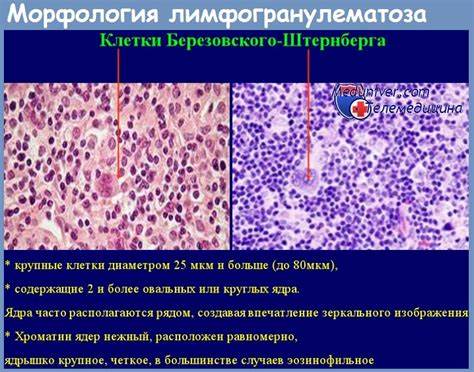 Диета при лимфоме не ходжкина Как чешется тело при лимфоме ходжкина Как чешется тело при лимфоме ходжкина Диета при лимфоме не ходжкина
