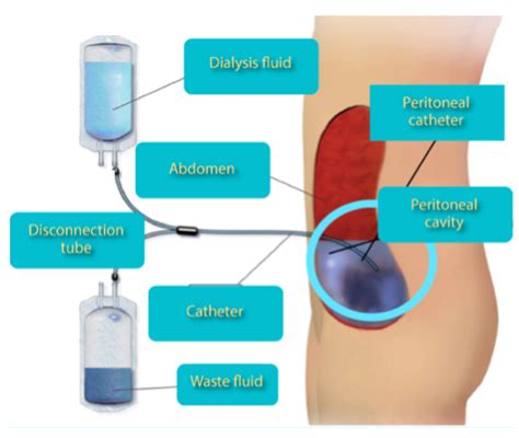 Peritoneal Dialysis Catheter