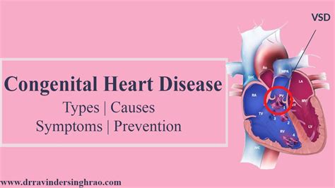 Congenital Heart Disease Types Causes Symptoms Prevention