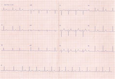 Blog de Eletrocardiografia FIBRILAÇÃO ATRIAL DIAGNÓSTICO E CONDUTA