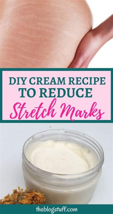Diy Stretch Marks Cream Recipe With Coconut Oil Diy Stretch Marks