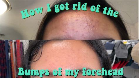How I Got Rid Of The Nasty Bumps On My Forehead Youtube