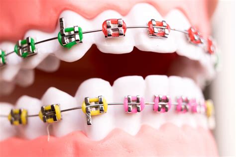 How Are Braces Put On A Step By Step Process [ Faqs]