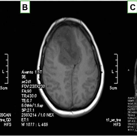 Brain Mri Of The Patient Axial Plane Of T1 Weighted Brain Mri A With