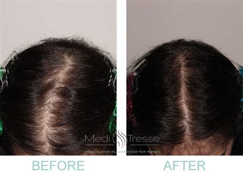 Discover More Than 75 Female Pattern Hair Loss Reversible In Eteachers
