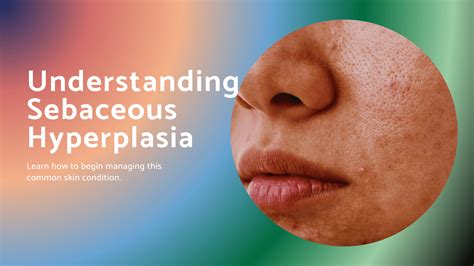 Sebaceous Hyperplasia Understanding And Managing Mantric