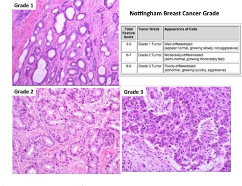 Table I From A Survey On Automatic Breast Cancer Grading Of