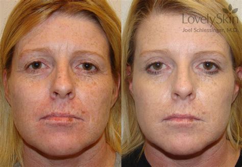 Omaha Cosmetic Dermatology Aquagold Treatments Skin Specialists Pc