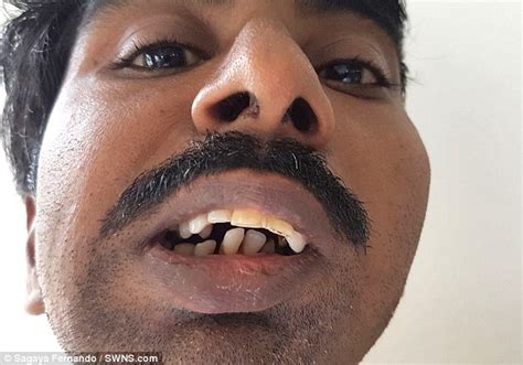 Malnourished Indian Man Eats Solid Food For The First Time Daily Mail