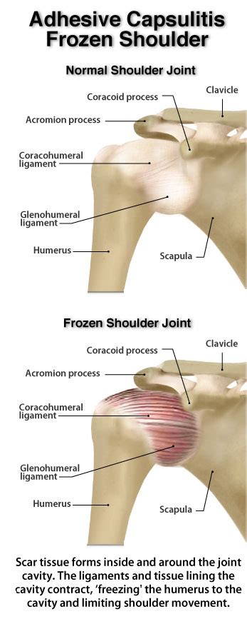Try keeping the elbow in and then look in the mirror, is your shoulder blade lower on the side that hurts? A Review of Current Frozen Shoulder Treatment Options ...