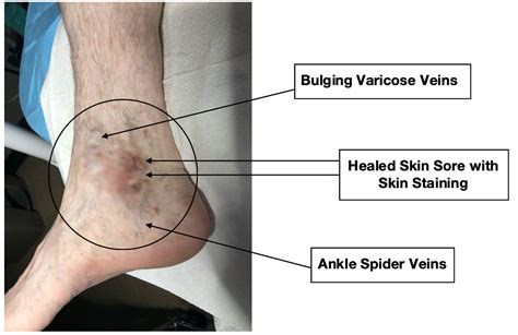 What To Look For 8 Spider Veins Skin Sore Staining Bulging Varicose