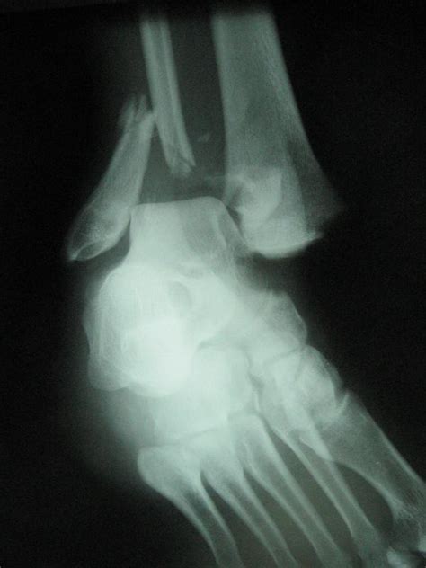 What Is A Distal Fibula Fracture With Pictures