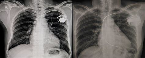 Permanent Pacemaker Insertion In The Philippines Phmc Blog