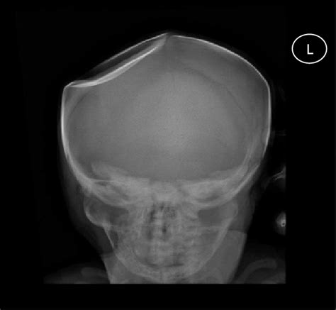 Anteroposterior Skull Radiograph Showing The Right Parietal Depressed