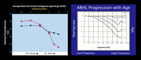 Hearing Loss Progression Horizontal Pacific Northwest Audiology