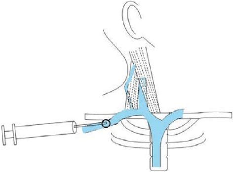 7 Subclavian Venous Catheterization With Infraclavicular Approach