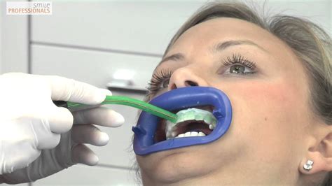 Kein frei käuflicher zahnaufheller kann den zahnarzt ersetzen. Bleaching / Zahnaufhellung - Zahnarzt Dr. Bär Müllheim ...
