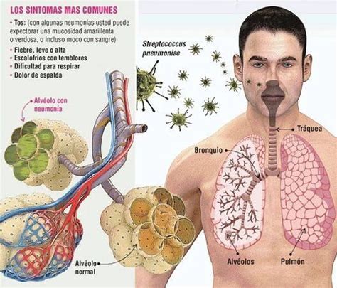 Enfermedades Del Sistema Respiratorio Causas Sntomas Y