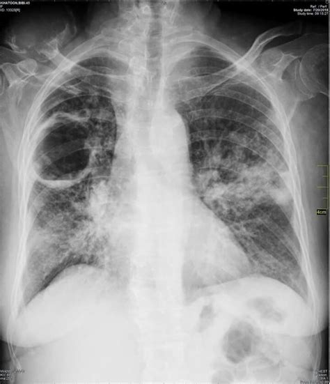 Initial Chest Xray Showing Old Scar Of Pulmonary Tuberculosis Without