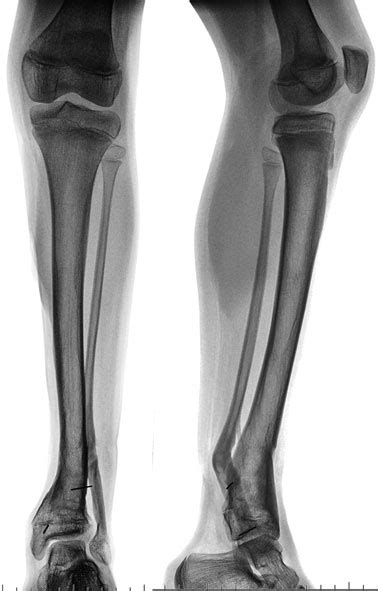 Ap And Lat Radiographs 8 Years After Frame Removal Before The Final