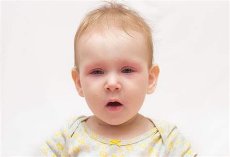 Slapped Cheek Syndrome Reasons Signs And Treatment