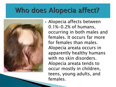 Ppt Alopecia Areata Powerpoint Presentation Id2370966