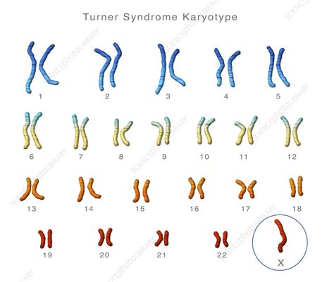 Turners Syndrome Karyotype Illustration Stock Image C0555470 Science Photo Library