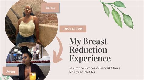 My Breast Reduction Experience Insurance Process Before After Youtube