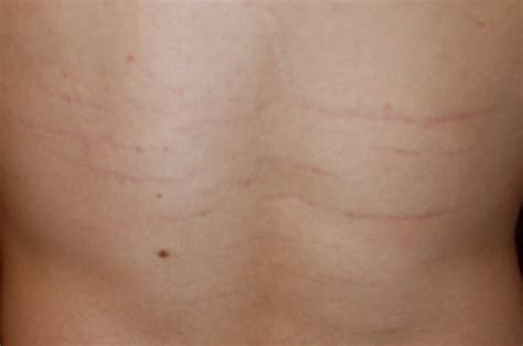 New users enjoy 60% off. Bartonella - Symptoms, Treatment, Pictures, Causes