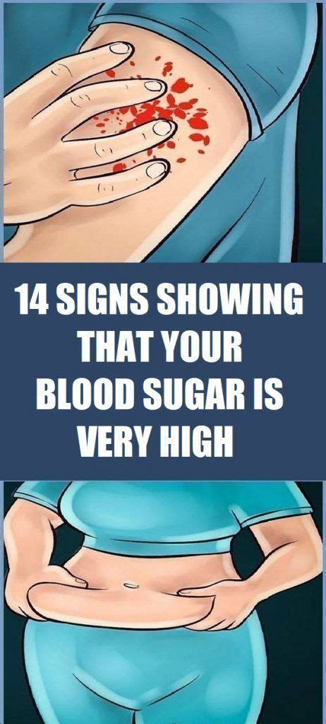 14 Signs Showing That Your Blood Sugar Is Very High Wellness Click