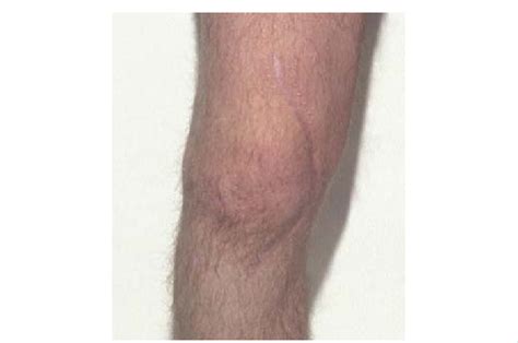 Close Up Of Healed Scar Following Knee Surgery Note The Curved Nature Download Scientific