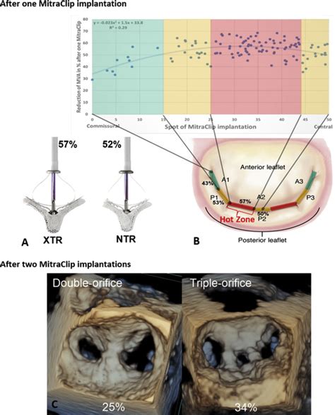 Anatomical And Technical Predictors Of Three Dimensional Mitral Valve
