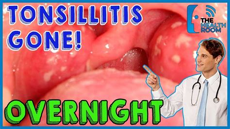 What Is Tonsillitis Proven Ways To Get Rid Of The Pain And Discomfort