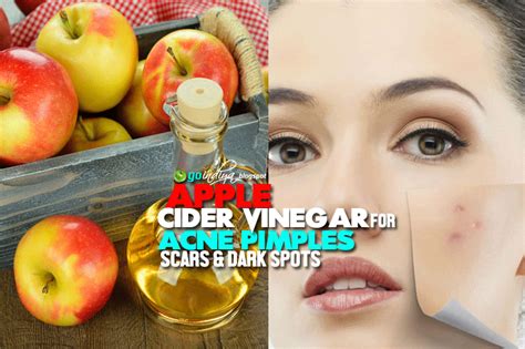 Apple Cider Vinegar For Acne Pimples Scars 5 Ways To Use Apple Cider