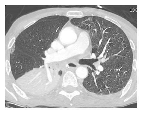 Ct Scan Of The Chest Showing Aspiration Pneumonitis Download