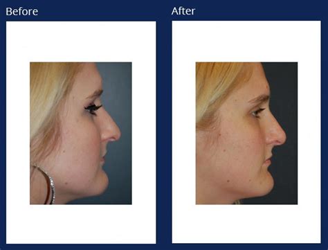 Light Chemical Peels Holzapfel Lied Plastic Surgery