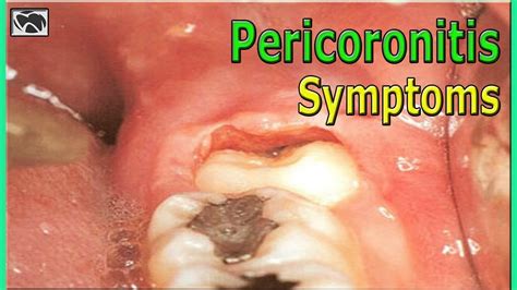 What Is Pericoronitis Causes And Symptoms Wisdom Teeth Youtube