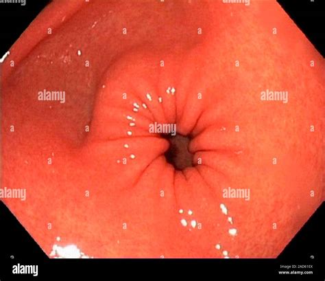 Pylorus Endoscopic View Of The Lower Section Antrum Of A Healthy