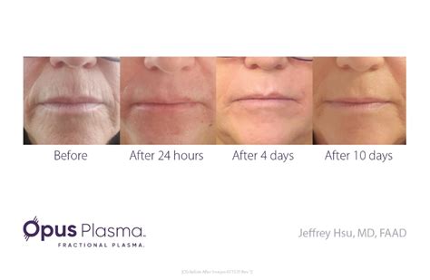 Laser Skin Resurfacing Treatments In Clearwater FL The Refinery