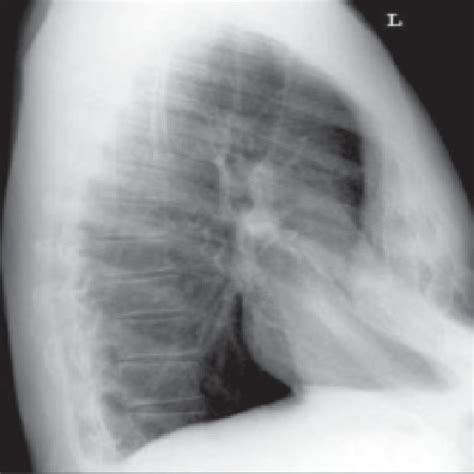Chest Radiograph Lateral View Showing Protrusion Deformity Of Sternum